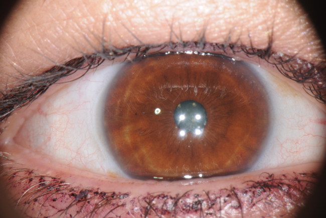 Photo of Raffaela Marescalco's eye for an iridology analysis.